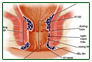 3 phương pháp điều trị bệnh trĩ phổ biến